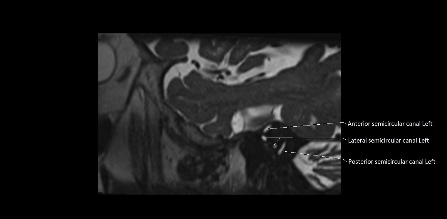 Cranial nerve sagittal anatomy MRI 3T image 3.webp